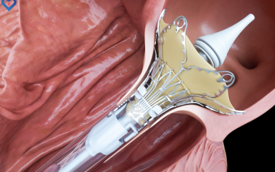 Interview with Dr. SarrafEpygon: A unique device for mitral valve repair